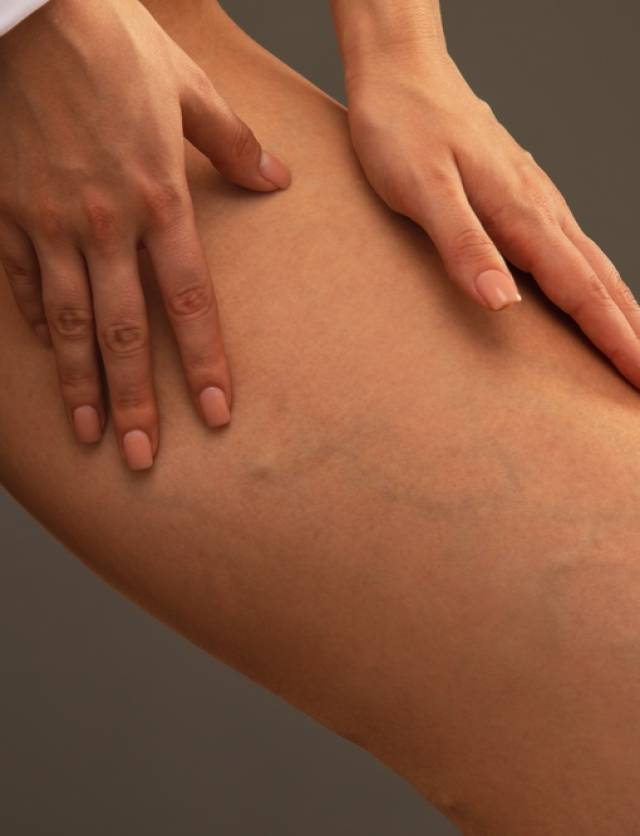 Beautiful,Slender,Woman,Shows,Varicose,Veins,On,The,Legs.,Treatment Beautiful,Slender,Woman,Shows,Varicose,Veins,On,The,Legs.,Treatment