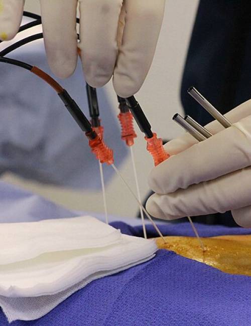 Radiofrequency Neurotomy (Endoscopic Method) Radiofrequency Neurotomy (Endoscopic Method)