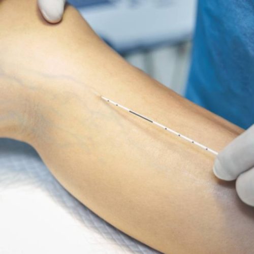 Varicose-Treatments-1-r61wvwe9tzreyf5lnhb283jqggnmww236mwq1wd5ew